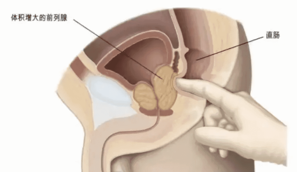 如何找到你的前列腺