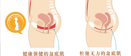 产后盆底肌如何修复丨产后盆底肌有问题怎么办？