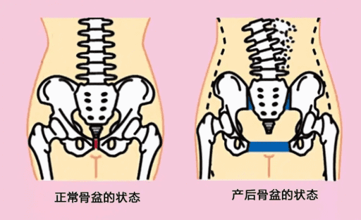 产后骨盆恢复的几个办法丨骨盆修复的妙招