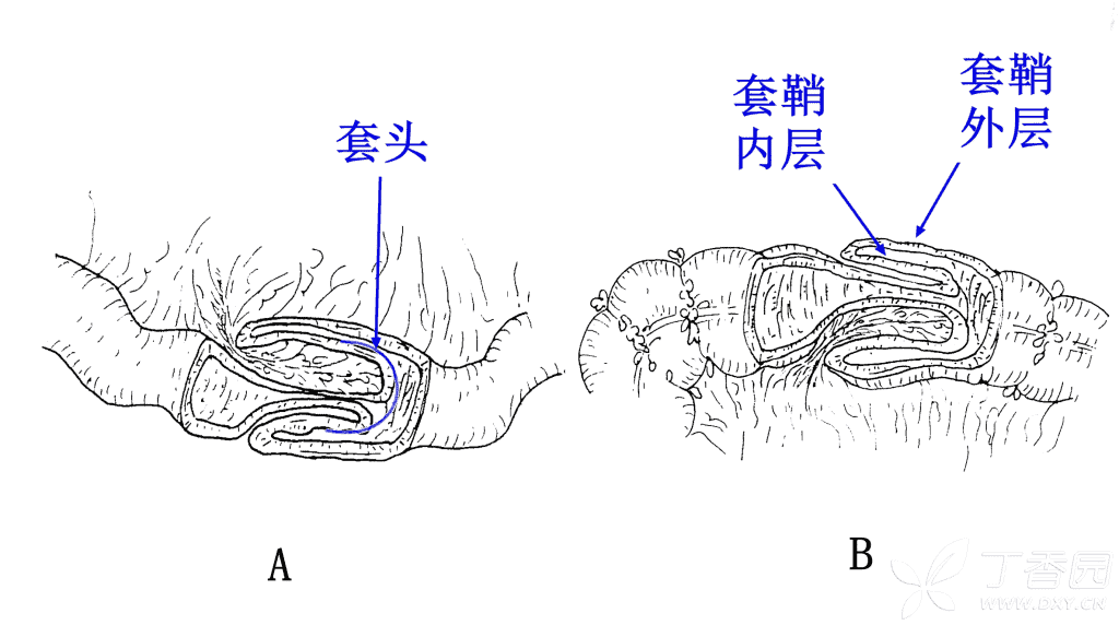 什么是肠套叠,宝宝肠套叠怎么办