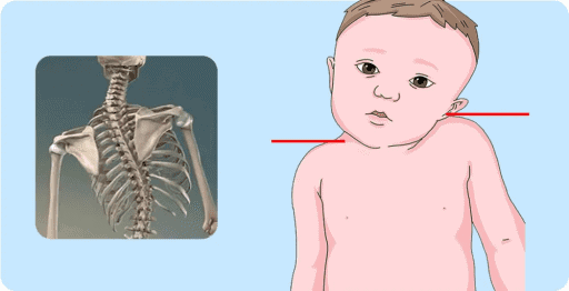 病因:这是较少见的类型,约占所有斜颈婴儿的2%,指的是因为骨骼的畸形