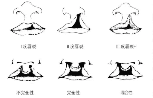 宝宝唇腭裂的成因,婴儿唇腭裂如何治疗