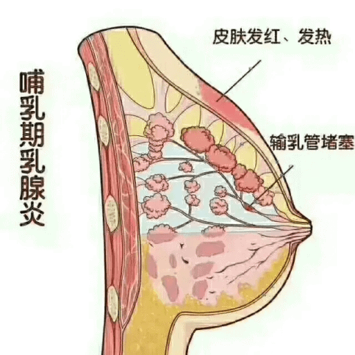 哺乳期乳腺炎怎么办丨一定要注意哺乳期乳腺炎