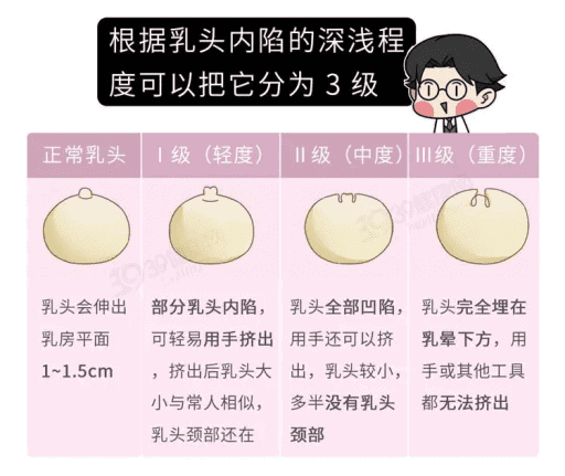 乳头凹陷怎么办？这几个方法可以纠正乳头内陷