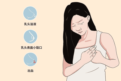 乳头皲裂该怎么办？这几个办法可以改善乳头破损